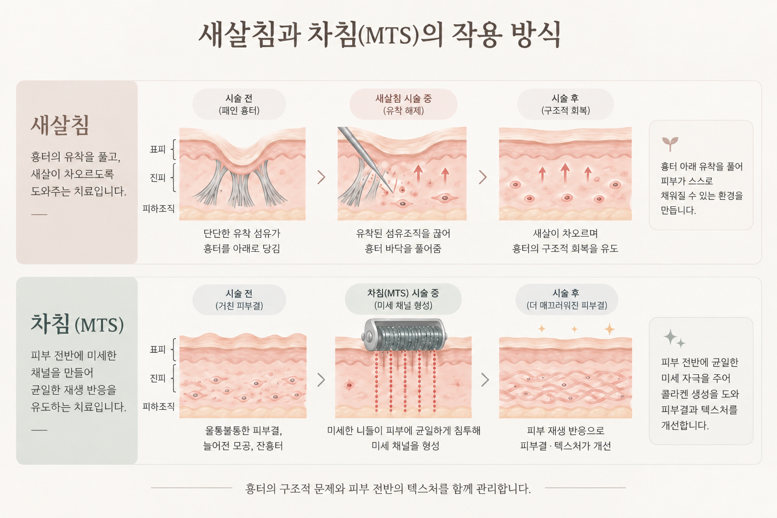 새살침과 차침(mts)의 서로 다른 작용 방식을 보여주는 그림