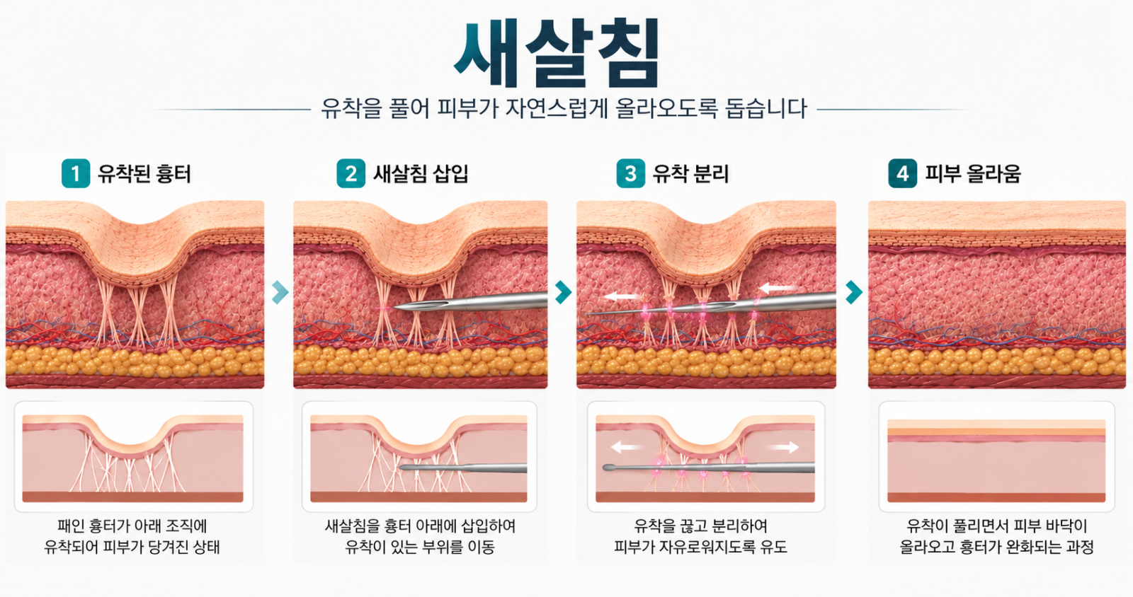 새살침 작용원리를 보여주는 그림