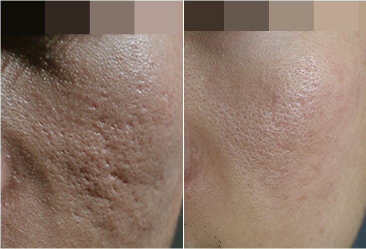 해율한의원 수원점 새살침+복합치료(차침, 프락셀, Co2, 연어약침) 6회 전후 비교 사진