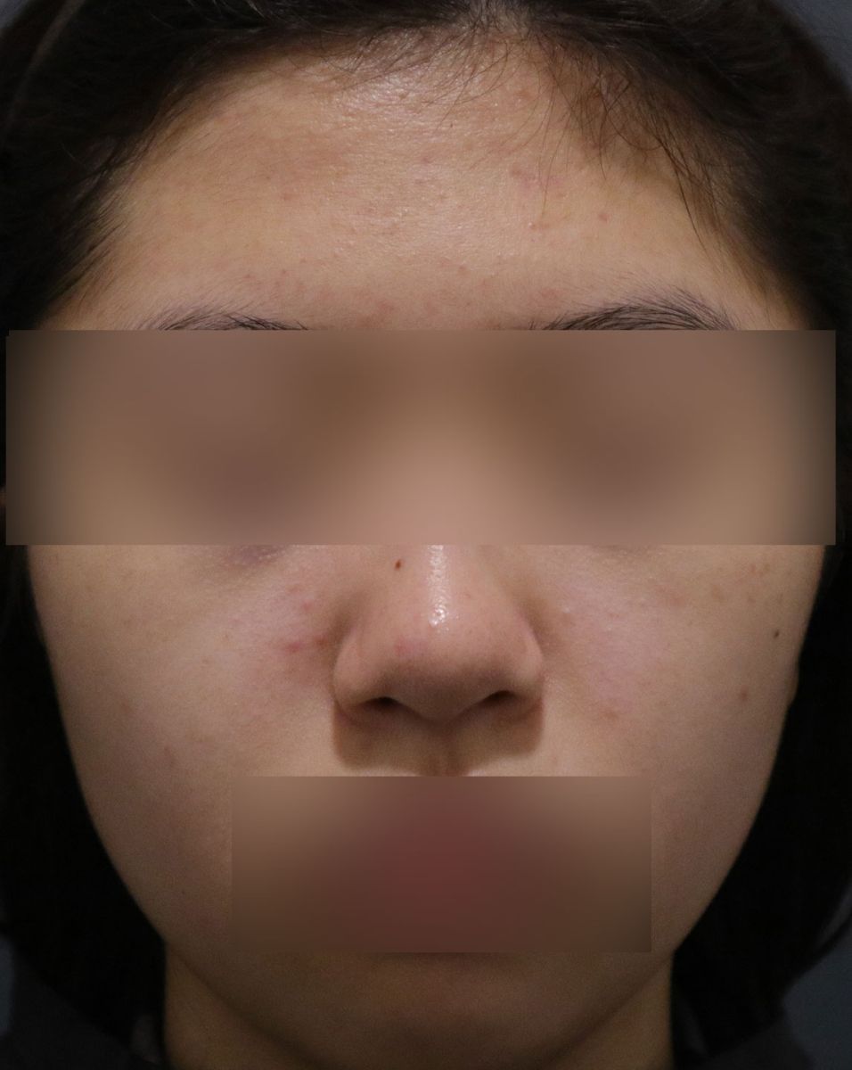 좁쌀 몇 개 정도의 가벼운 면포성 사춘기 여드름을 보여주는 사진
