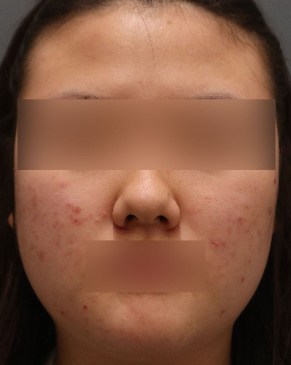붉은 염증성 여드름이 여러 개 섞인 사춘기 여드름을 보여주는 사진