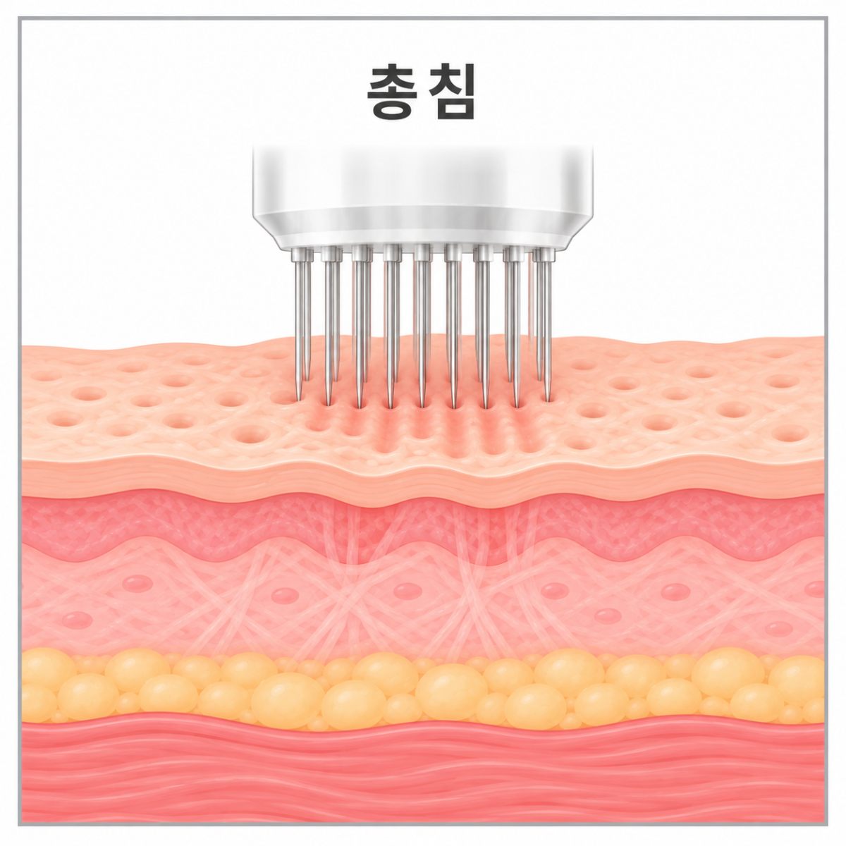 총침의 작용방식을 보여주는 사진