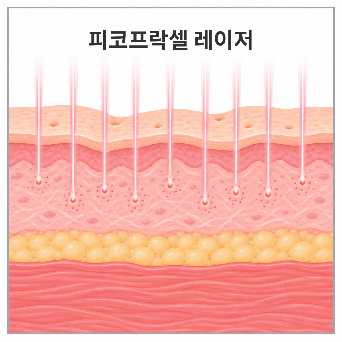 피코프락셀 레이저의 작용방식을 보여주는 사진