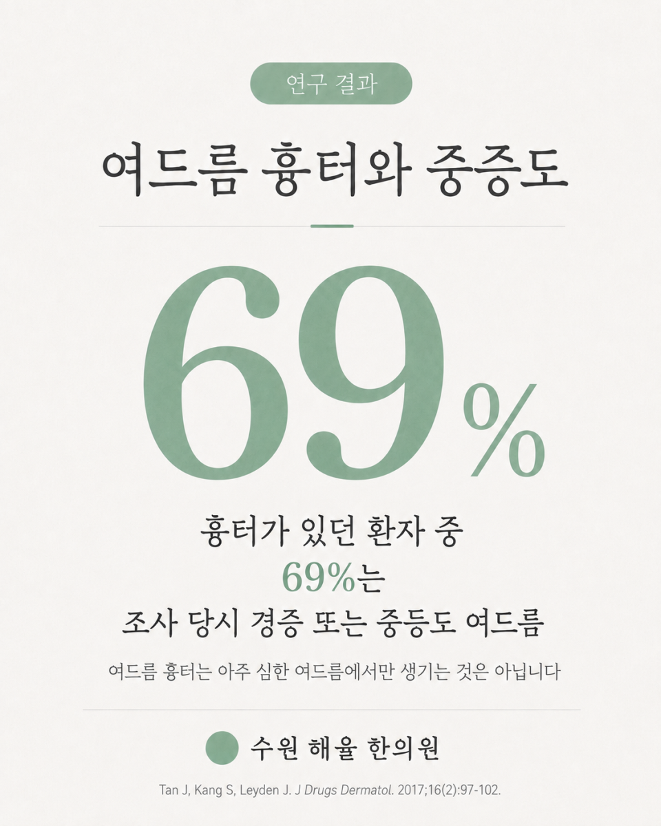 조사한 여드름 흉터 환자 중 69%는 경증 또는 중등도 여드름이었다는 연구 결과를 보여주는 사진