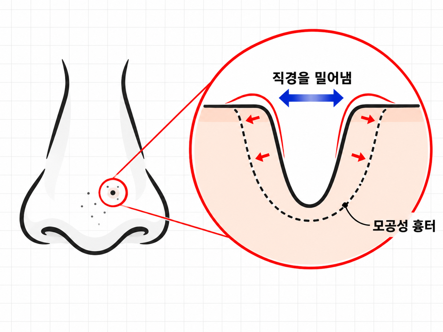 염증 이후 모공 주변 조직이 비후되면서 모공 직경이 넓어진 모습을 보여주는 그림  ​