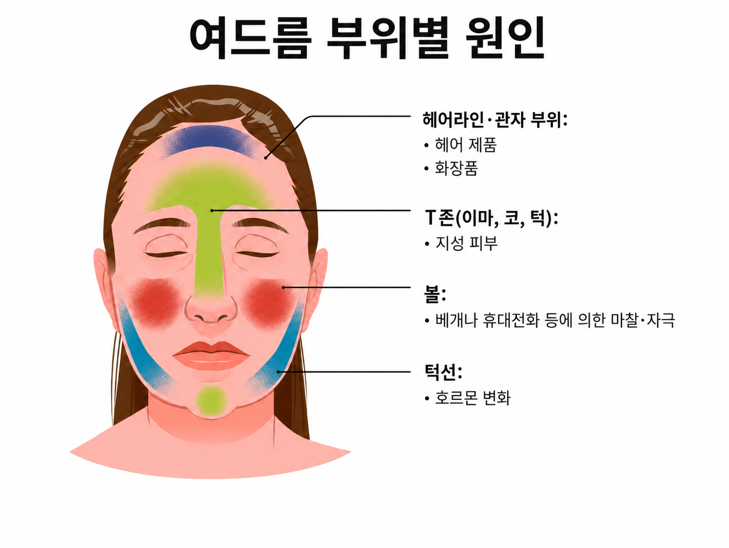 여드름 부위별 원인을 보여주는 그림